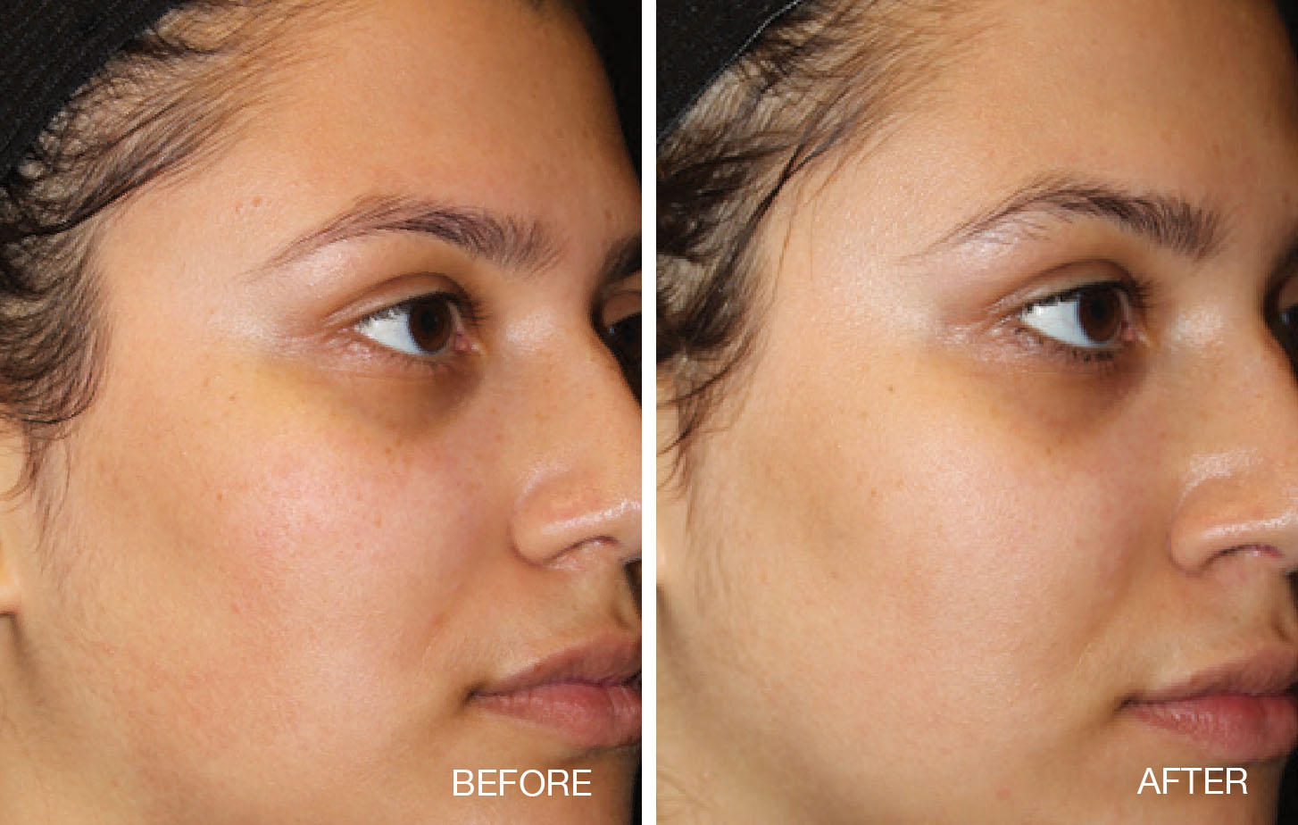 Clear + Brilliant Before and After