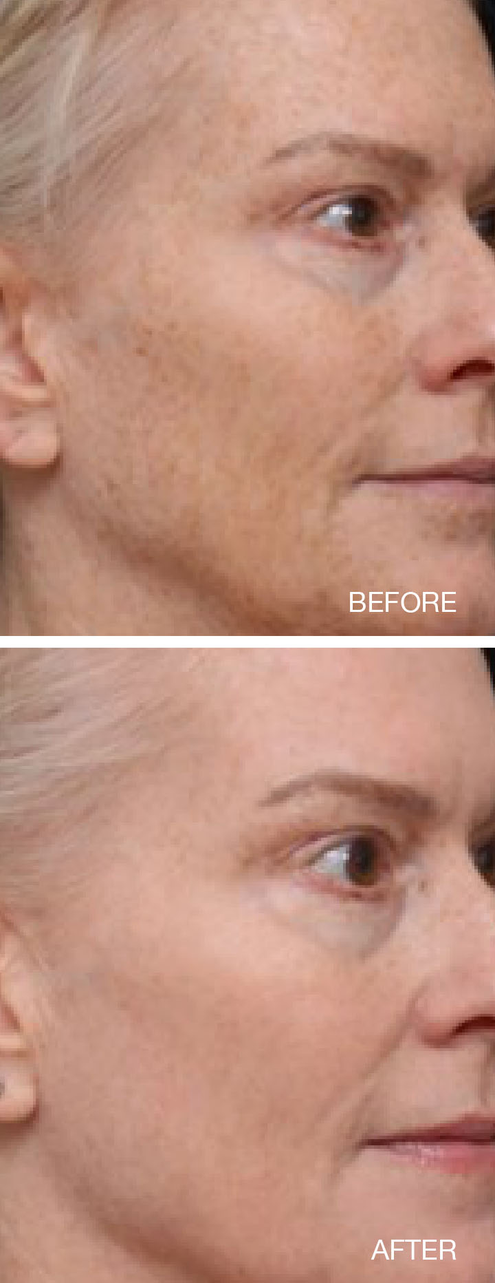 Fraxel FTX Before and After