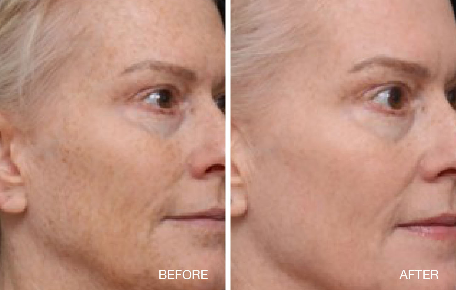 Fraxel FTX Before and After