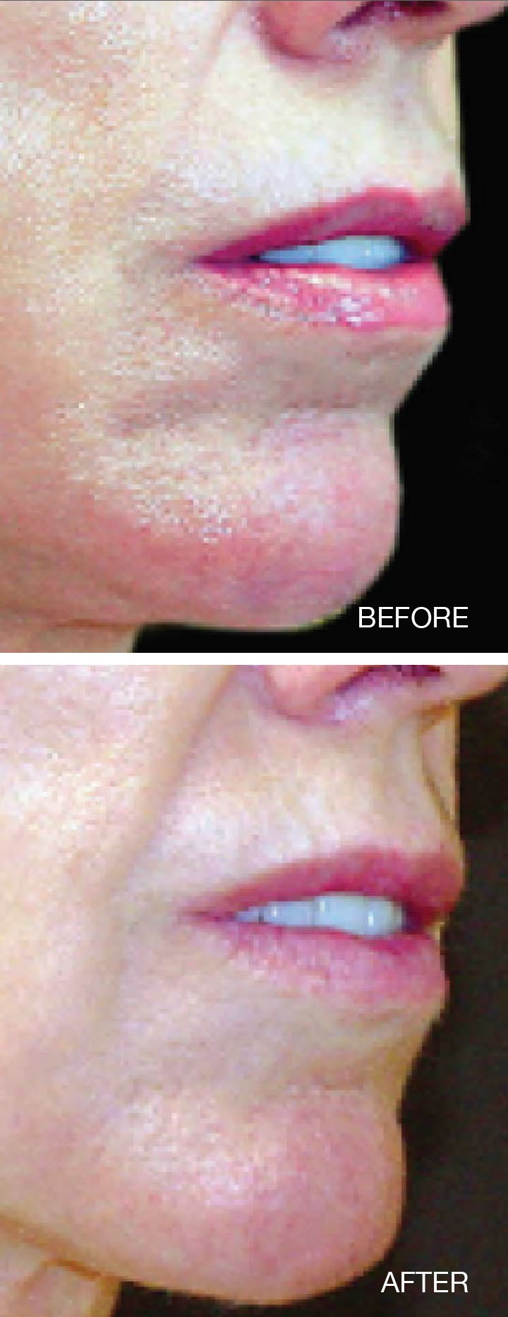 Thermage FLX Before and After